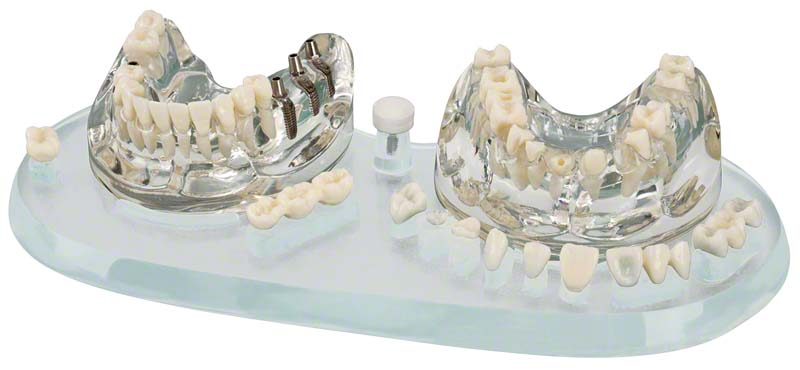 Studienmodell Demo Implant C&amp;B